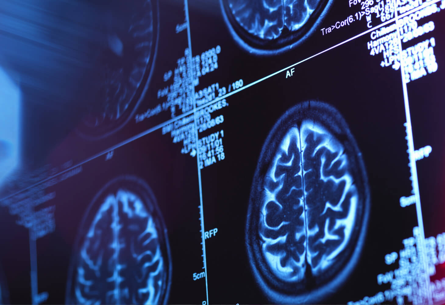 Brain scan